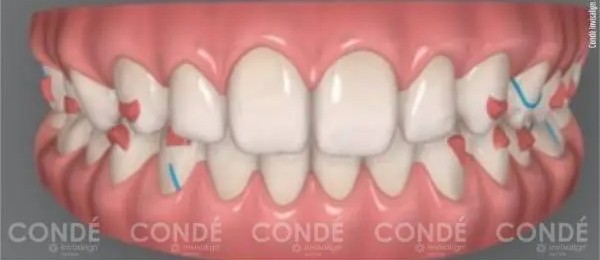 Condé – Invisalign Doctor